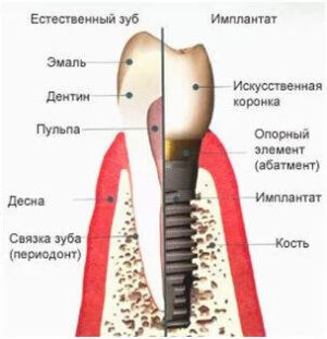 Имплант схема установки