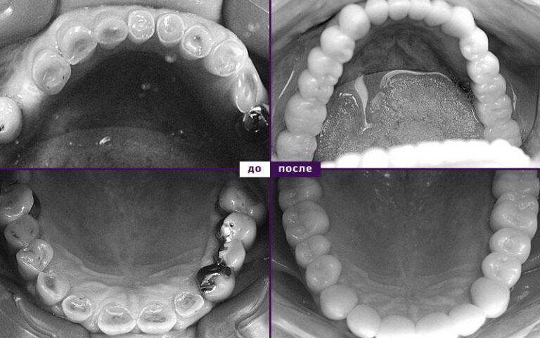 Напыление коронок цирконием зубных фото