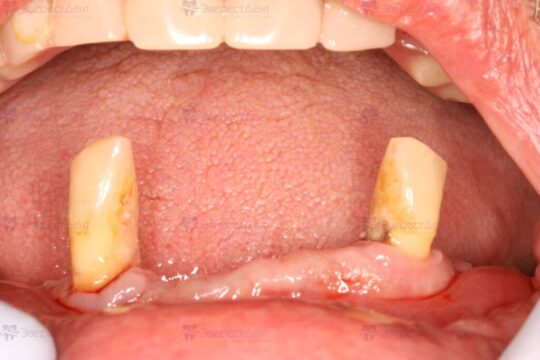 Фото примера зубов до тотального протезирования