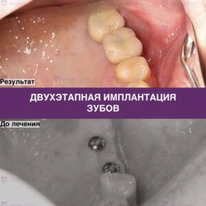 Пример двухэтапной имплантации зубов в Минске