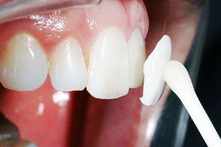 Установка люминиров на зубы