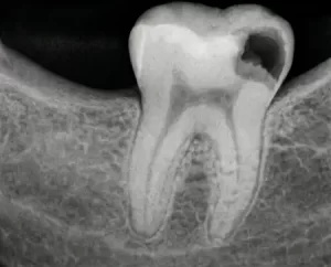 Лечение кариеса зубов