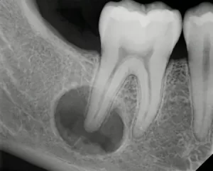 Снимок зуба с кистой