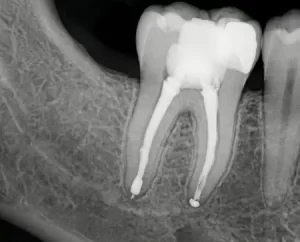 Снимок после лечения каналов