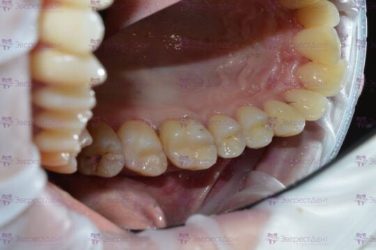 Фото лечения кариеса на жевательных зубов