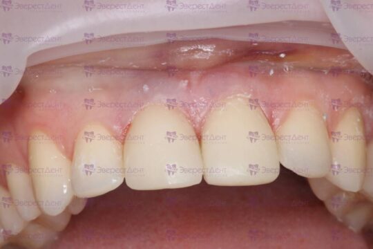 Фото результата реставрации зуба