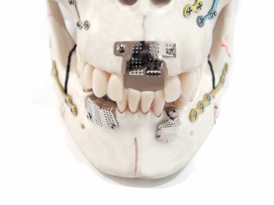 Направленная костная регенерация (НКР) с использованием титановой сетки