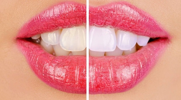Отбеливание зубов в стоматологии - фото