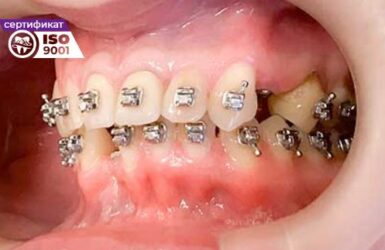 Пример работы по комплексной реабилитации зубов до