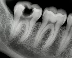 Снимок зуба с пульпитом Снимок зуба с пульпитом