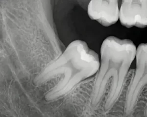 Удаление зуба мудрости Снимок Ретенция зуба