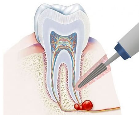 Резекция верхушки корня зуба в стоматологии