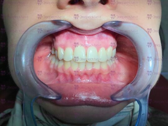 Фото ровных зубов после исправления прикуса