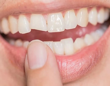 Травма зуба в зоне улыбки