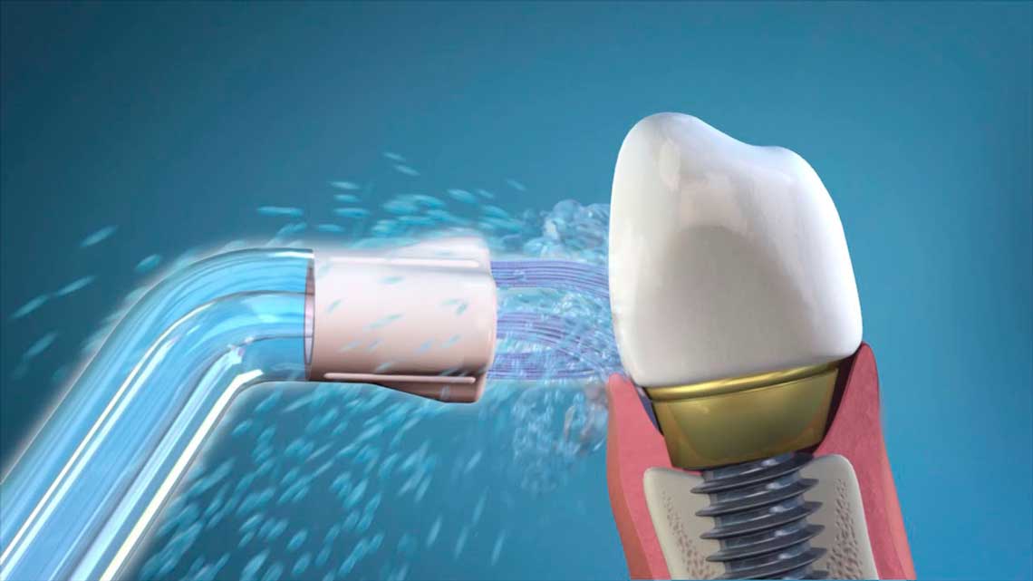 Уход за имплантами