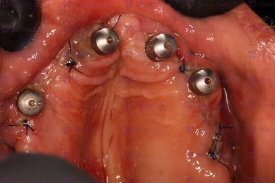 Фото установки имплантов в челюсти