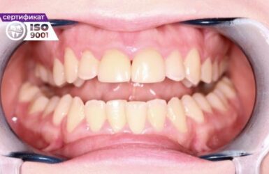 Пример работы установка циркониевых коронок на 11 и 21 зубы после