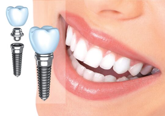 Пример установки зубного импланта