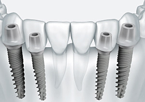 Преимущества современных имплантов зубов