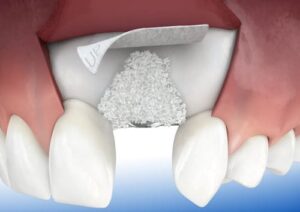 Восстановление костной зубов Удаление зубов под наркозом Томск Пархоменко