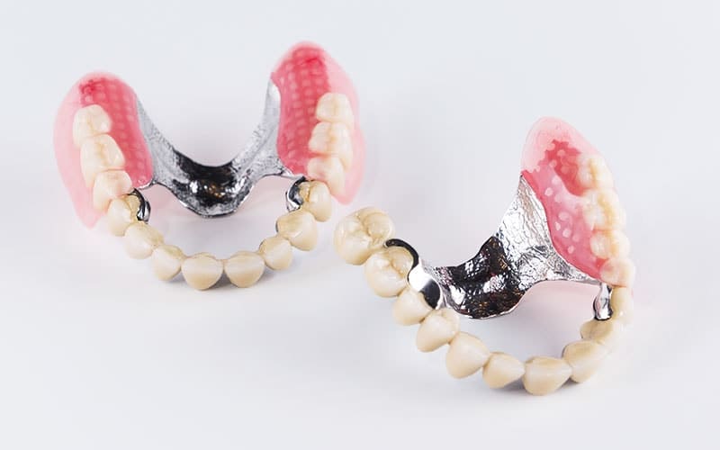 Виды бюгельных протезов в стоматологии