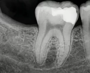 Пломбирование зубов Пломбированный зуб