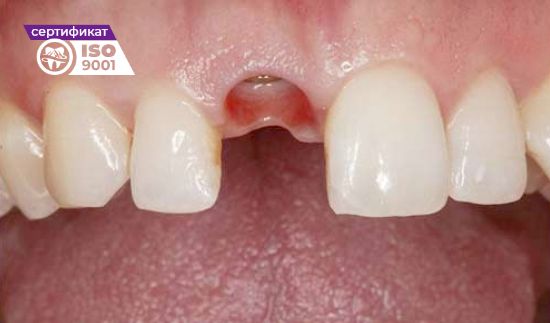 Пример имплантации переднего зуба до