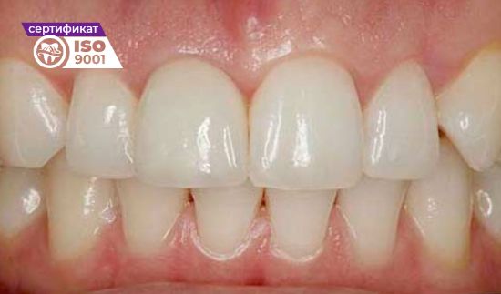 Пример имплантации переднего зуба после