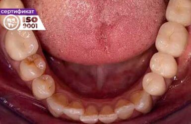 Пример имплантации зубов верхней челюсти после.