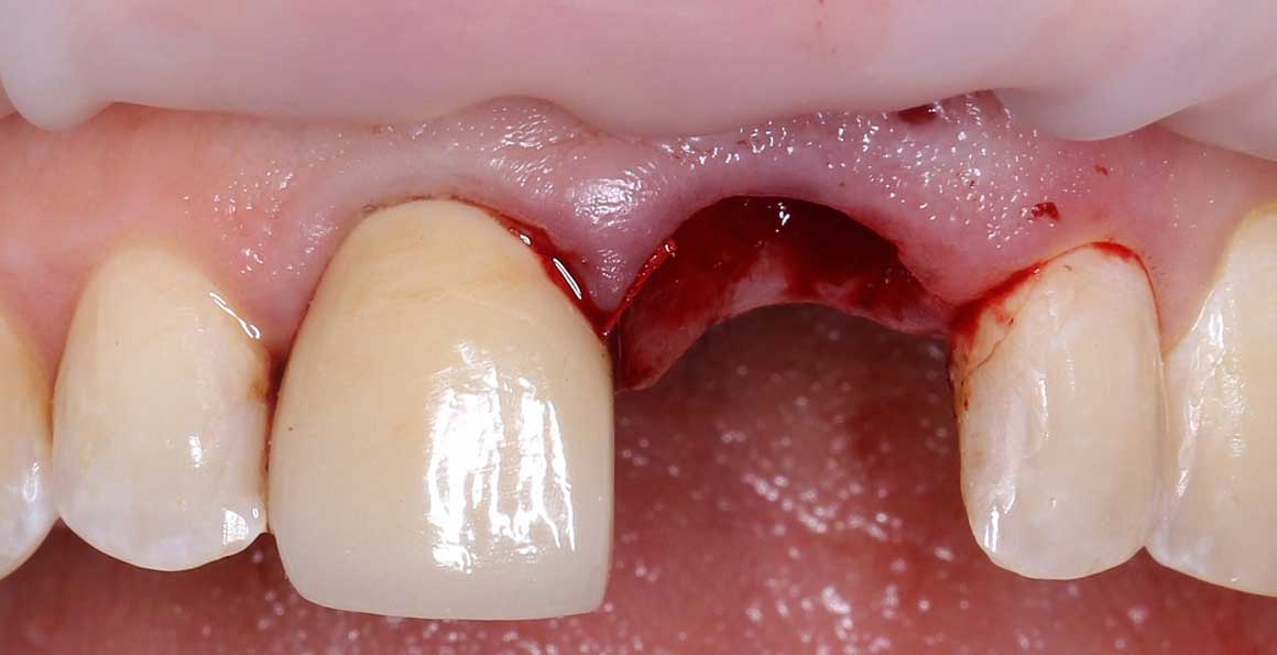 Резорбция зубов
