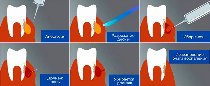 Как понять что абсцесс зуба