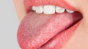 Жжение во рту или синдром горящего рта: симптомы и лечение