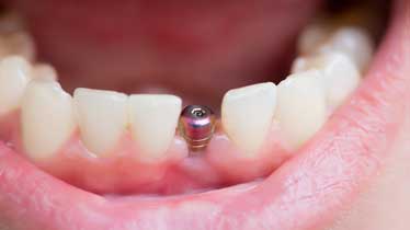 Отторжение зубного имплантата