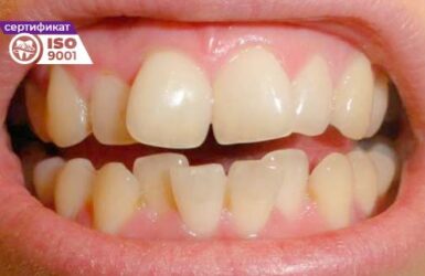 Пример работы исправления зубного ряда передних зубов до