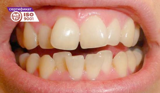 Пример работы исправления зубного ряда передних зубов до