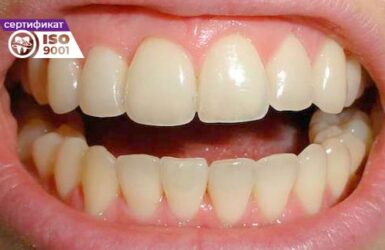 Пример работы исправления зубного ряда передних зубов после