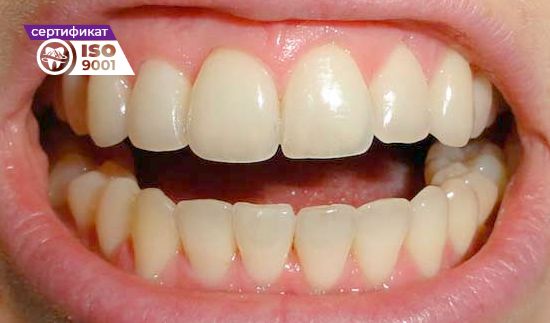 Пример работы исправления зубного ряда передних зубов после