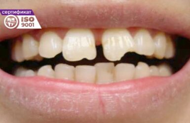 Пример работы по исправлению двух передних зубов до