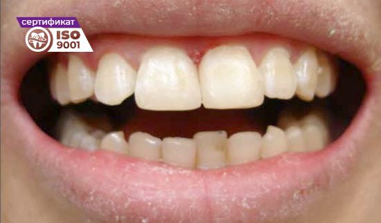 Пример работы по исправлению двух передних зубов после