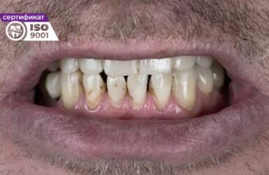 Пример работы исправления нижних передних зубов до