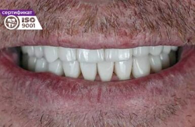 Пример работы исправления нижних передних зубов после