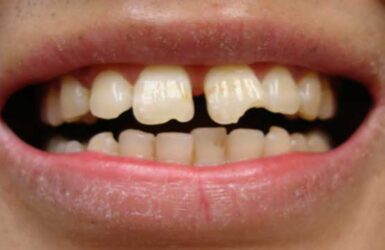 Исправление передних зубов
