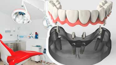 Классическая или базальная имплантация зубов?