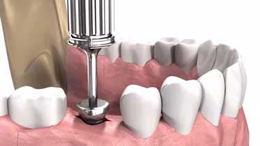 формирователь десны