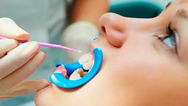 Реминерализация эмали зубов