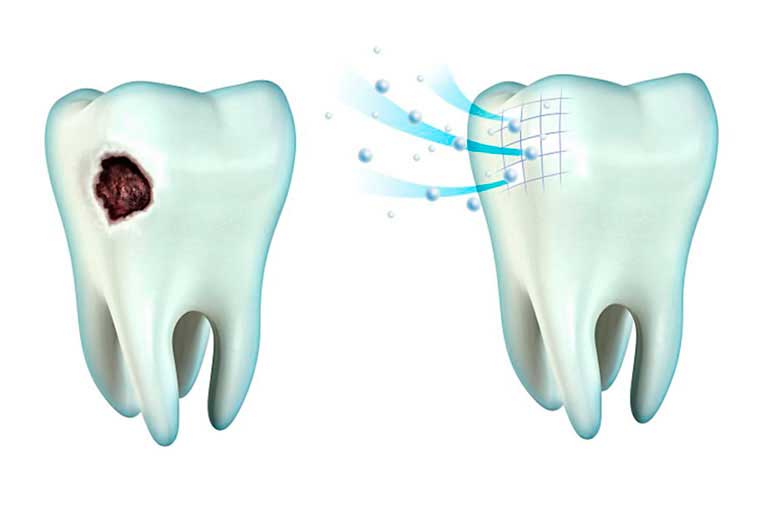  Реминерализация эмали зубов