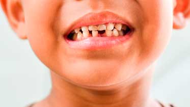 Гипоплазия эмали зубов