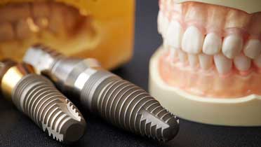 Приживаемость зубных имплантов