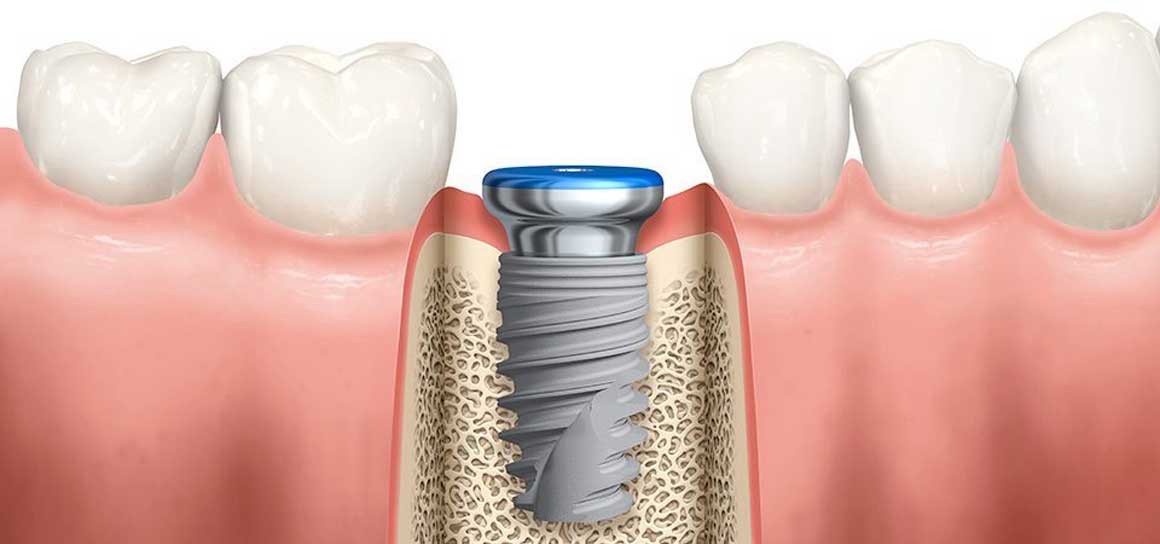 Приживаемость зубных имплантов