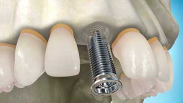 Нужен ли имплант зуба, если нет только одной зубной единицы